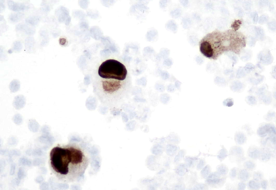 Peritoneal effusion with an unexpected guest. 
ICC (on smear) leaves no doubt.....Cytomegalovirus infection. 🧐🫣🎯💡🔬
#Cytopath, what else?