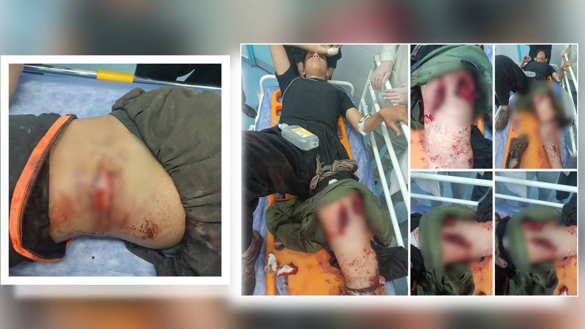 Kolbarnews_En's tweet photo. #Iran #Kurdistan
❗️Two Child Kolbars Injured by Direct Shooting of Border Forces
According to Kolbarnews, on Sunday evening, April 28, 2024, #border_forces opened fire on a group of #Kolbars at the #Nowsud border, injuring two 16-year-old #Kurdish #child_Kolbars from the villages of "Balbazan" and "Darehbiyan" in Paveh County.
Both of these childs were transferred to #medical_centers in the city of #Paveh for treatment.
Identity of one of these child Kolbars, "#Parsa_Hosseini," 16 years old, from the village of "Balbazan" in the suburbs of Paveh, has been reported.
This Kolbar has been severely #injured in the thigh area and is currently undergoing treatment in medical centers in Paveh, with his condition being unfavorable.
Furthermore, another 16-year-old child laborer, identified as "#Sahand" (last name unknown), from the village of "Darehbeyan" in the suburbs of Paveh, has been severely injured by #gunfire in the back and hip areas.
…
More info:
https://t.co/Qa04BqcTLk
#Kolbarnews
#JinaAmini
#MahsaAmini
#protest