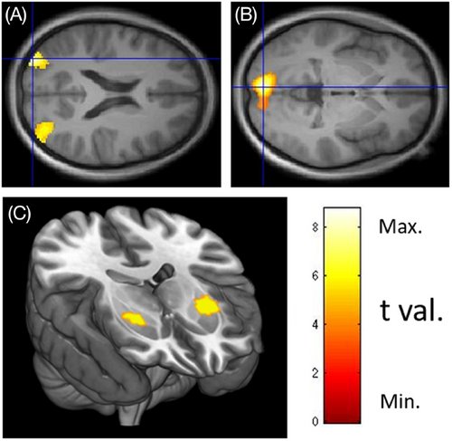 Neural correlates of chocolate brand preference: A functional MRI study. This article is free to read. #fMRI #chocolate #neuroimaging #neurology #neurotwitter #neuroscience #neurorad #radre onlinelibrary.wiley.com/doi/full/10.11…