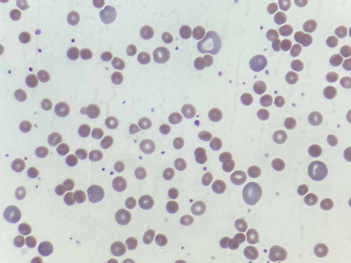 #MorphologyMonday

With a haemoglobin of 63 g/L, and a really high retic count, a blood film was made.

What's going on? 

#OnlyCells #bloodfilm #anaemia