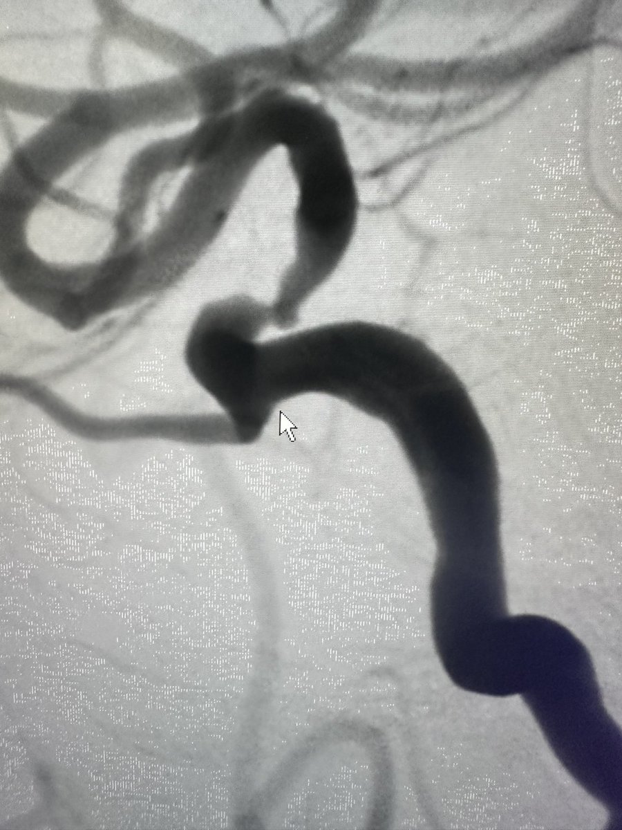 RitamGhoshMD's tweet image. 50 year old female with recurrent watershed strokes despite medical management who presented with severe supraclinoid ICA stenosis. Treated with new Onyx Frontier stent from @Medtronic. Easier delivery with faster results  for our patients @JeffHealthNJ @TJUHNeurosurg