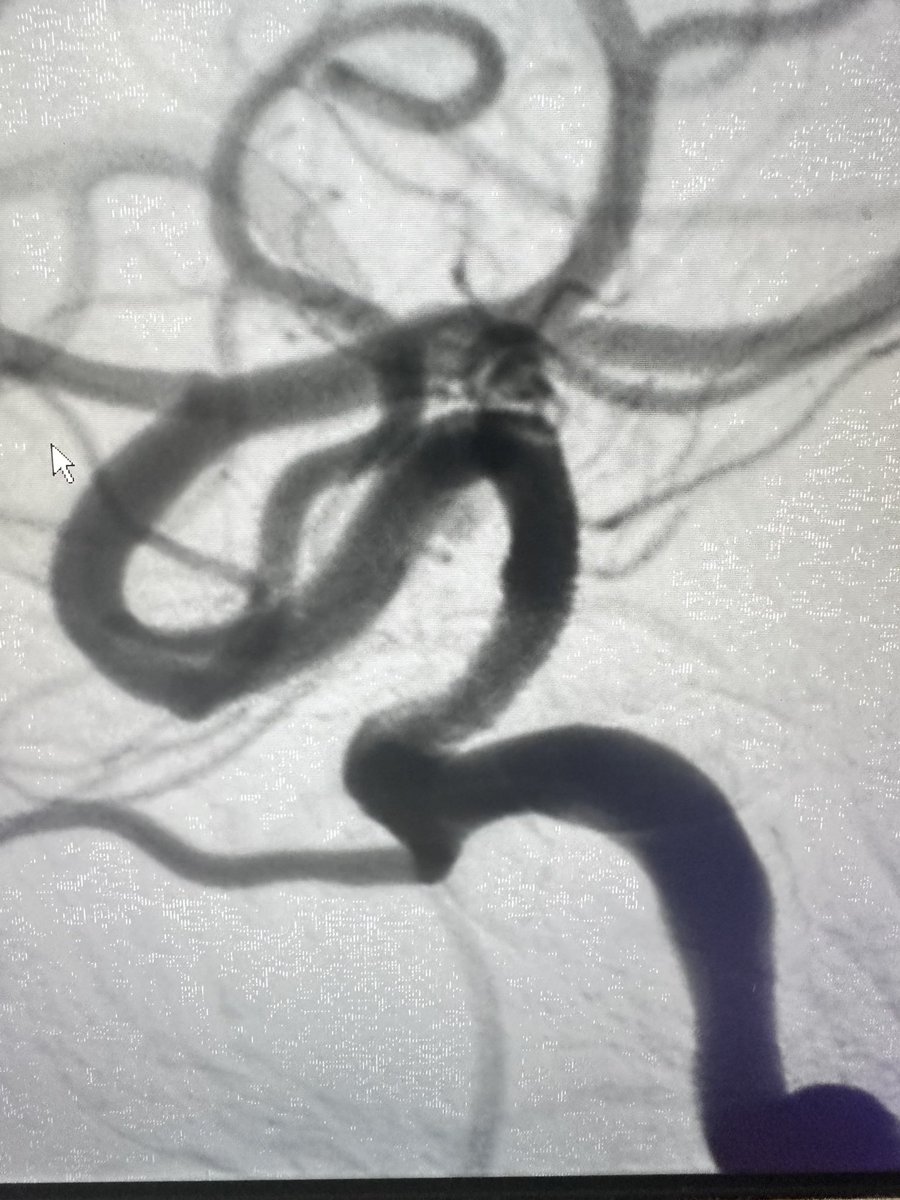 50 year old female with recurrent watershed strokes despite medical management who presented with severe supraclinoid ICA stenosis. Treated with new Onyx Frontier stent from @Medtronic. Easier delivery with faster results for our patients @JeffHealthNJ @TJUHNeurosurg