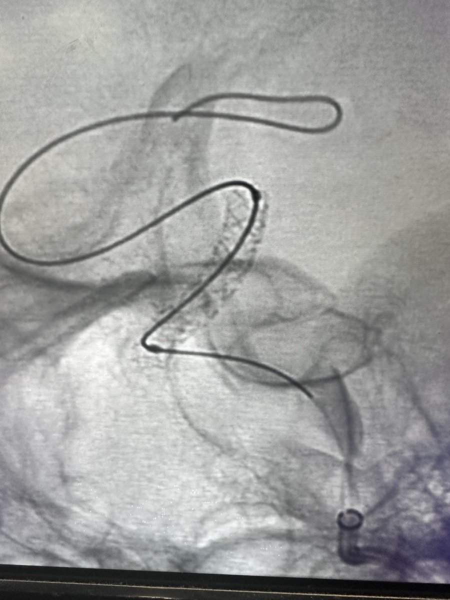 RitamGhoshMD's tweet image. 50 year old female with recurrent watershed strokes despite medical management who presented with severe supraclinoid ICA stenosis. Treated with new Onyx Frontier stent from @Medtronic. Easier delivery with faster results  for our patients @JeffHealthNJ @TJUHNeurosurg