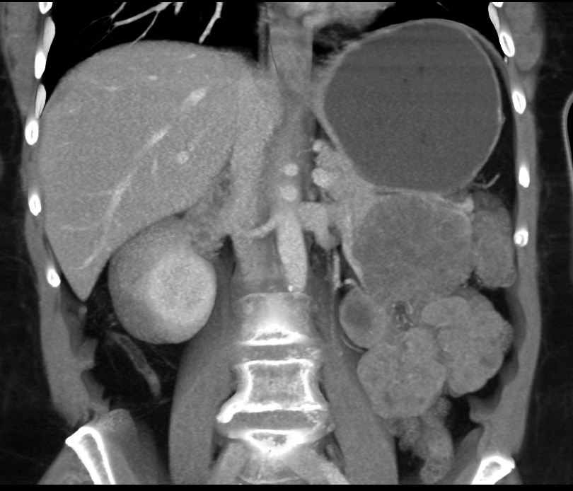 serous cystadenoma 4cm