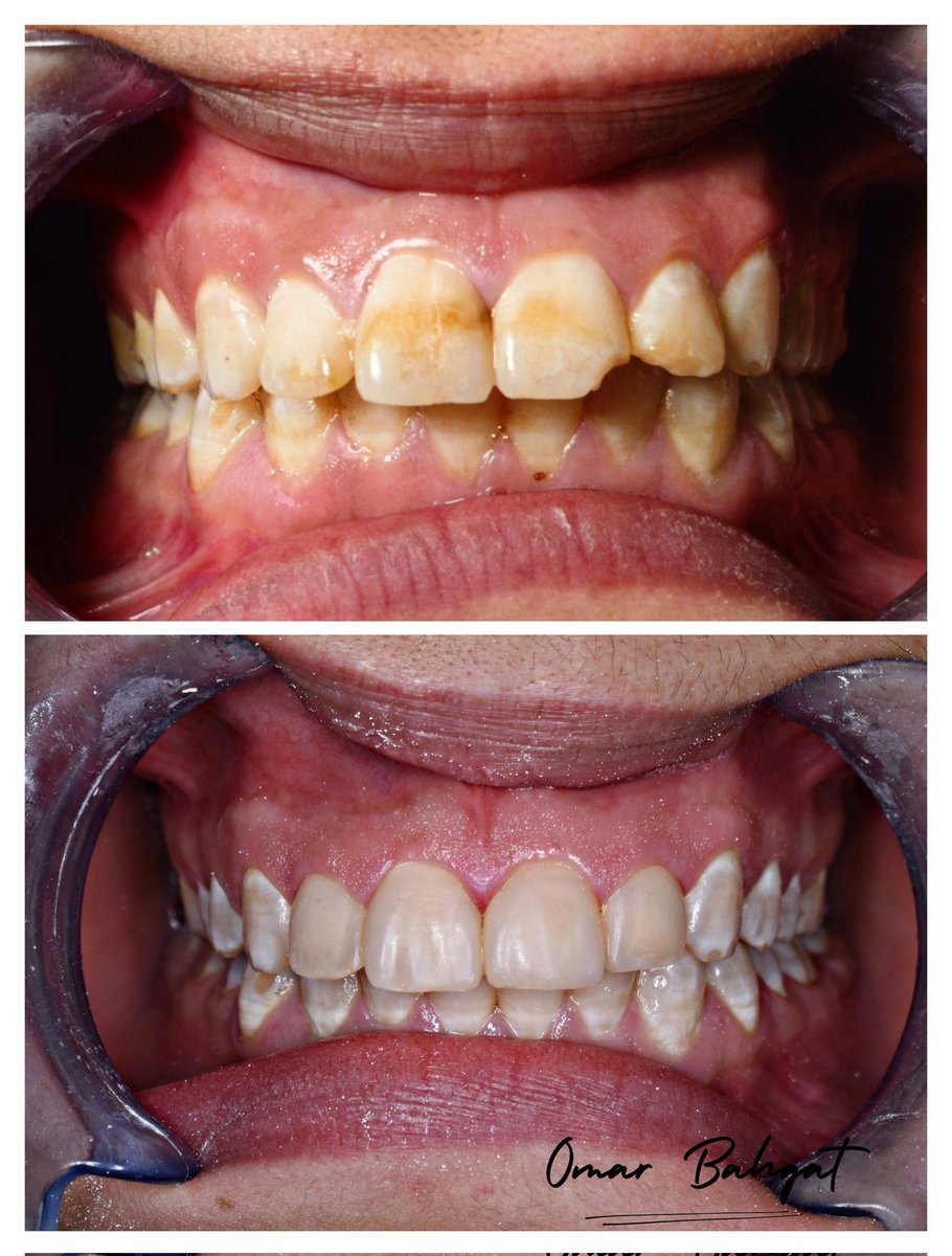 Direct Composite Veneer 🤝🪄