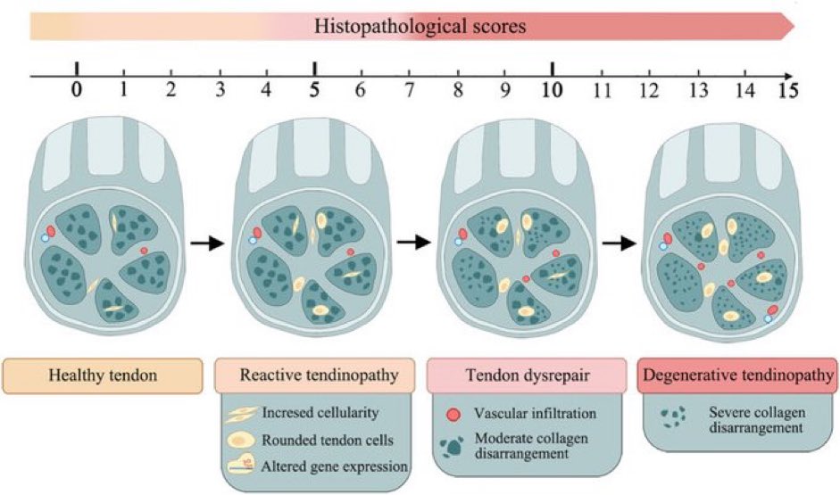 Continuum model of Tendinopathy Healthy Tendon ⬇️ Reactive Tendinopathy (⤴️cellularity, rounded tendon cells, altered gene expression) ⬇️ Tendon Dysrepair (vascular infiltration, collagen disarray) ⬇️ Degenerative Tendinopathy (severe collagen disarray) ncbi.nlm.nih.gov/pmc/articles/P…