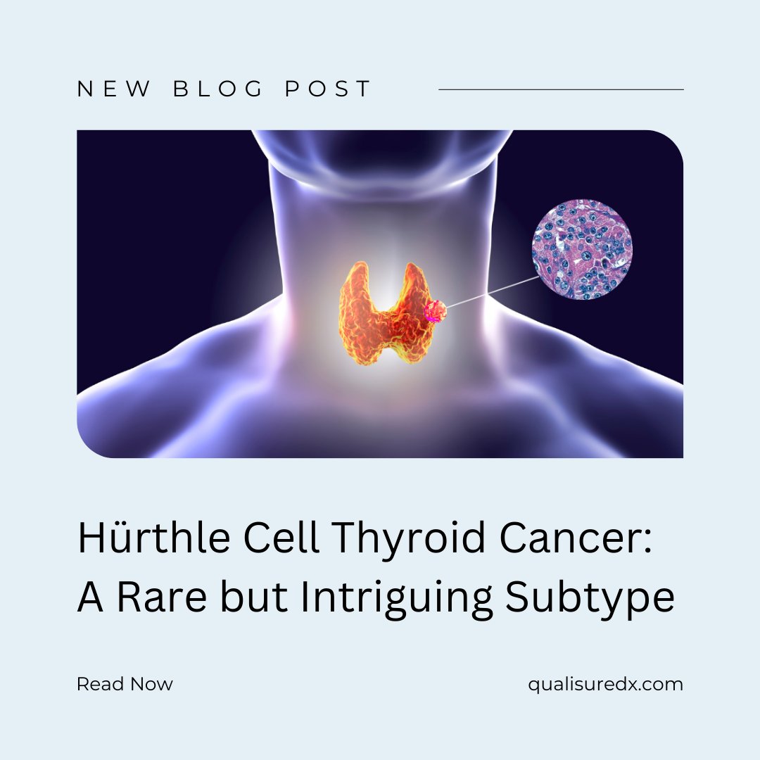 Learn more about the intricacies of Hürthle cell thyroid cancer on our blog, where we cover diagnosis, treatment, and prognosis. 

qualisuredx.com/hurthle-cell-t…

#Thyroid #ThyroidCancer #ThyCa #MedTwitter #EndoTwitter #CancerIsPersonal #Blog #PrecisionOncology #Oncology #CancerCare