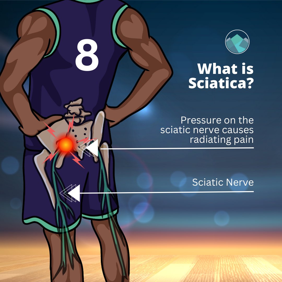 🚨 Sciatica refers to pain that travels along the path of the sciatic nerve. The sciatic nerve travels from the lower back through the hips and buttocks and down each leg.

#backpain #health #sportsmed #Sciatica #sportsinjury #healthcare #chiro #chiropractic #chiropractor #pt