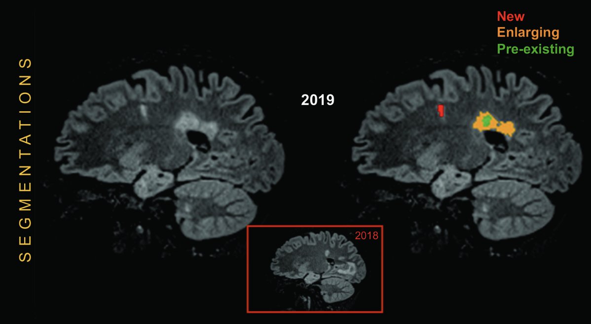 The Use of Contrast-enhanced MRI in At-risk Patient Populations Learn more ➡️ bit.ly/4b0LpwM @nuromri #Radiology #Imaging #GBCA #MRI #NeuroImaging