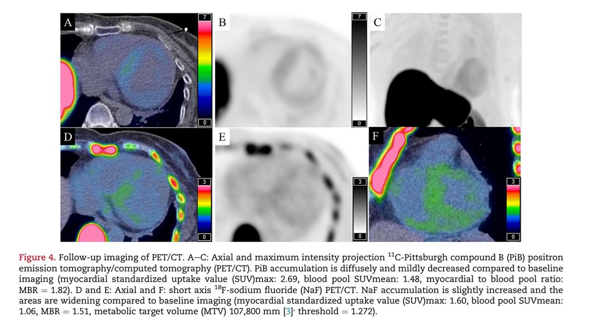 A case of PiB and NaF PET/CT imaging in a patient with ATTR-CA before and after Rx with Tafamidis. #amyloidosis #ThinkAmyloid Read here👉bit.ly/3xVm34x #CVNuc @MyASNC