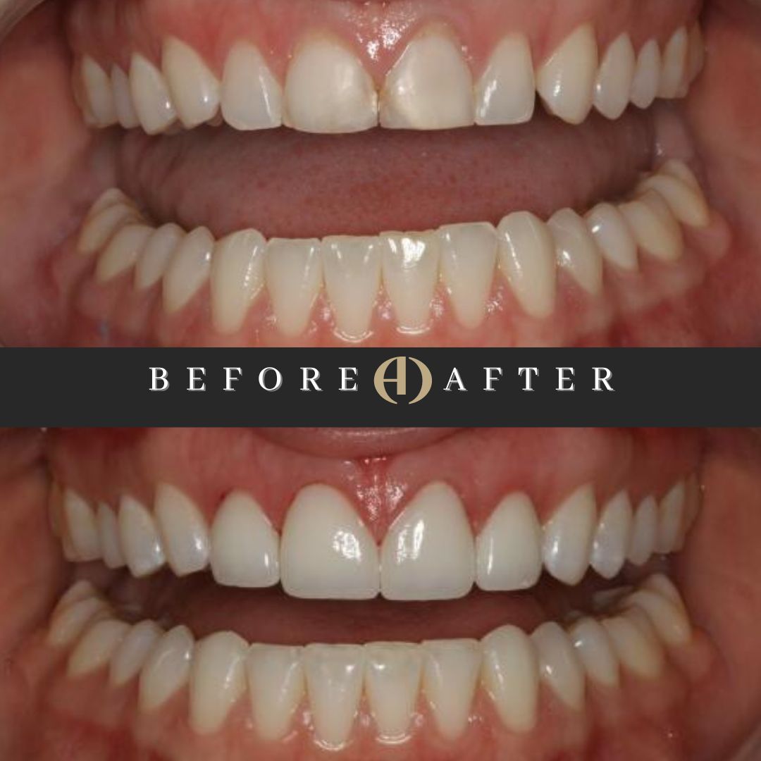 Cosmetic makeover #MakeoverMonday
Treatment done by Dr Dean Chencharik @cosmetickingdmd
.
.
#dentist #dentistry #dental #cosmetic #cosmeticdentistry #nj #newjersey #veneers #laminates #crown #dentalcrown #dentalimplants #smile #smiles #teeth #tooth #rdh #dentalhygienist