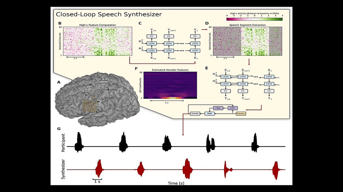 In @NaturePortfolio @SciReports (bit.ly/3Uk6IlA): Man with #ALS with implanted #BrainComputerInterface makes audible, intelligible words with near normal sound & pace. @HopkinsMedicine @HopkinsPlastic #HopkinsNeurology #NeuroplasticSurgery