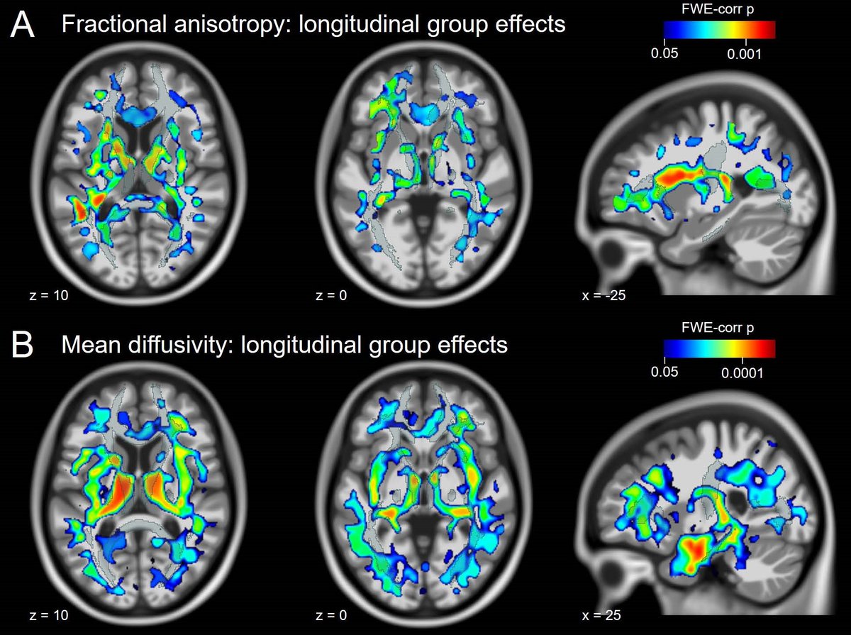 SfN Journals (@sfnjournals) on Twitter photo New in #JNeurosci: <a href="/MartaGarop/">Marta Garo Pascual, PhD</a> et al. <a href="/The_Strange_Lab/">TheStrangeLab</a> <a href="/Fund_CIEN/">Fundación CIEN</a> compared the brains of elders who don't experience cognitive decline with those who do & found brain white matter structural differences. jneurosci.org/lookup/DOI/10.… New in #JNeurosci: <a href="/MartaGarop/">Marta Garo Pascual, PhD</a> et al. <a href="/The_Strange_Lab/">TheStrangeLab</a> <a href="/Fund_CIEN/">Fundación CIEN</a> compared the brains of elders who don't experience cognitive decline with those who do & found brain white matter structural differences. jneurosci.org/lookup/DOI/10.…