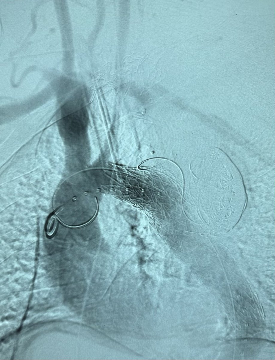 Completion image for this case. #AortaEd LSA so large difficult to place coils. Utilized amplatzer plugs (2) to occlude LSA, attempted to coil first, but as can be seen in image, coils just feel into aneurysm sac