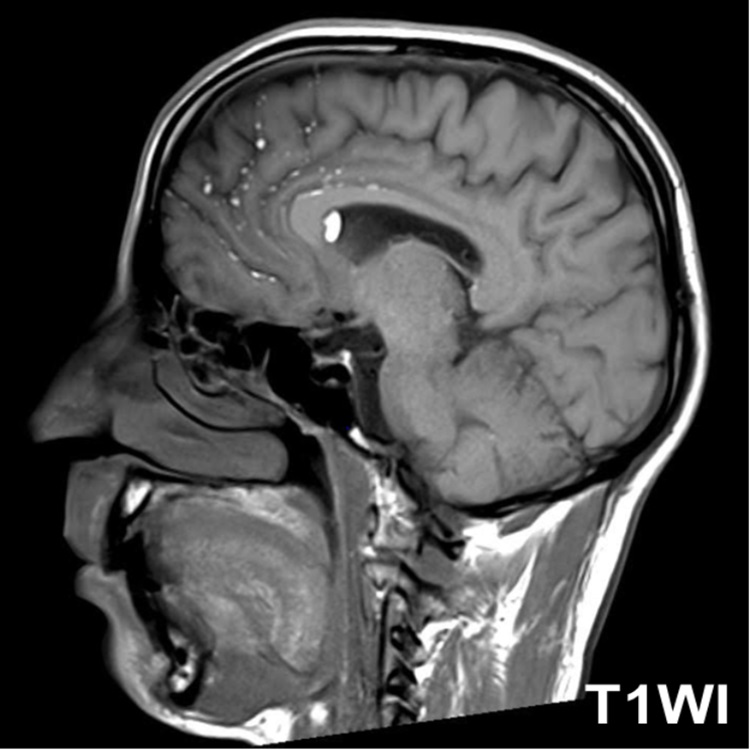 #AJNRcc >> April 29, 2024 >> What is the diagnosis for this 42-year-old man with frontal headaches evolving for 3 weeks? Submit your answer at ow.ly/ZWKM50RrblM.