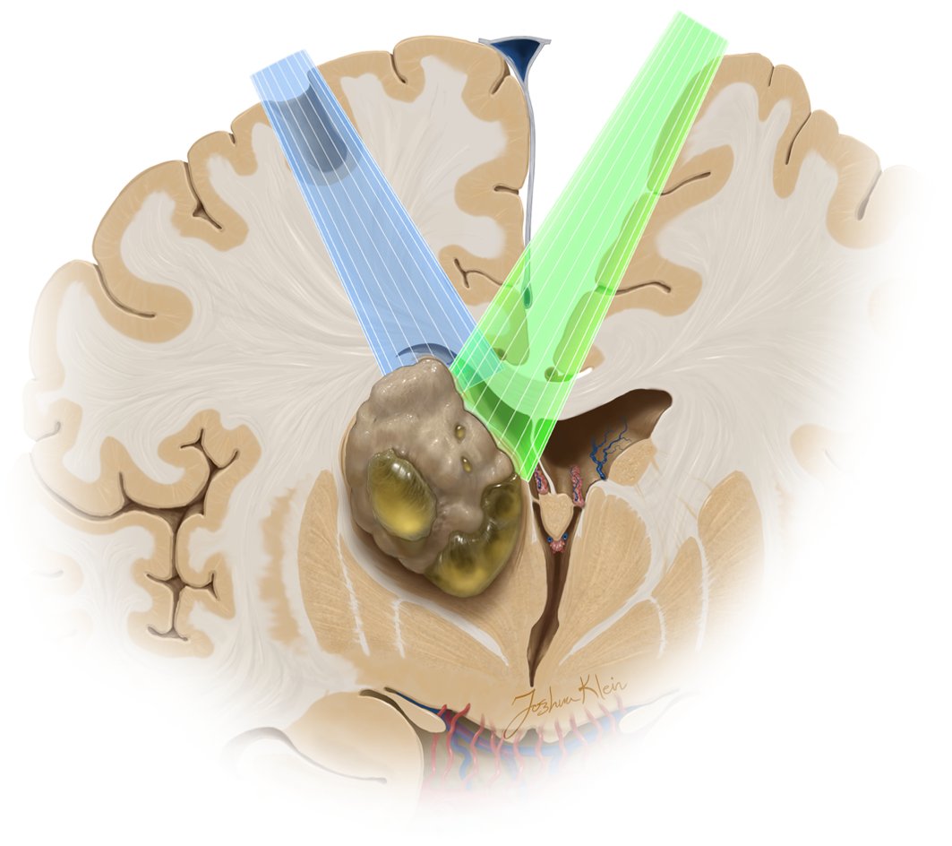 The contralateral anterior interhemispheric transcallosal approach is used to reach the lateral thalamus. The contralateral lateral ventricle is entered after the callosotomy in a cross-court trajectory (green). Learn more here: zurl.co/Tv6U #MedTwitter #NSGY #surgery