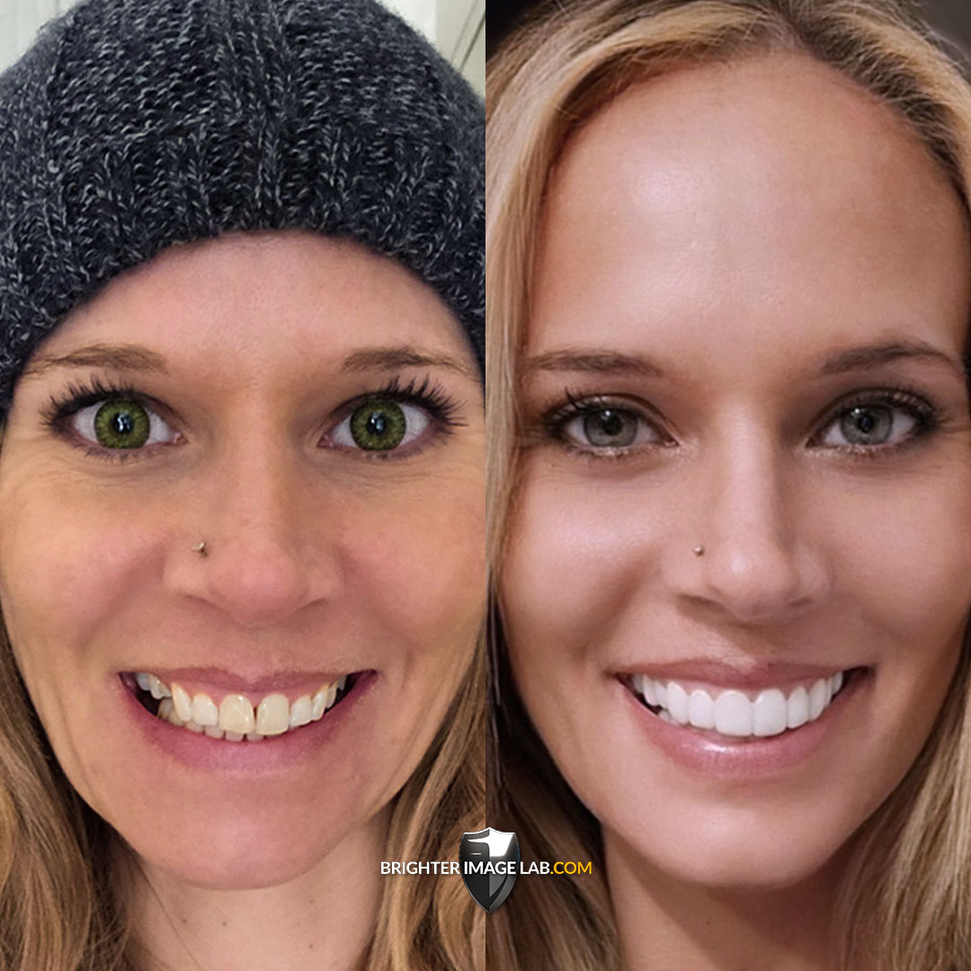 Guess who's beaming after getting her new smile? 😁 Seeing that radiant smile light up our day reminds us why we do what we do.☀️

#SmileMakeover #newsmilejourney #radiantsmilesahead #beforeandafter #dentalveneers #removeableveneers  #BILveneers #IncrediBIL #BrighterImageLab