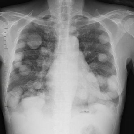 #CXR
#Sign

What is the diagnosis?

#MedEd 
#MEDHM 
#MedX 
@IhabFathiSulima