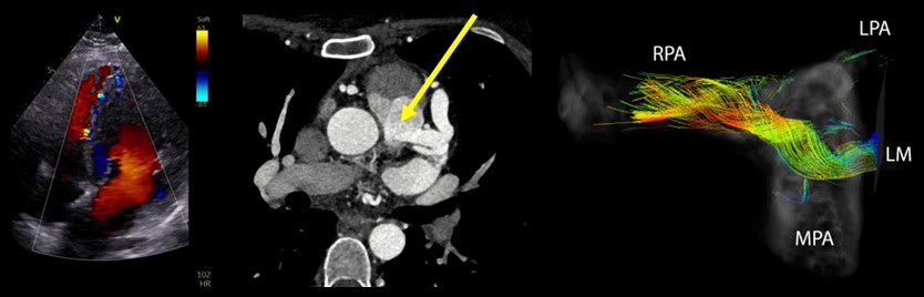 Adult Type ALCAPA: 4D-Flow CMR unveils high coronary flow & steal phenomenon. Imaging is important for diagnosis & surgical guidance. Repair of aberrant LM crucial for dual-coronary system @MPradella #AHAJournals @JiwonKimMD @kaznegishi ahajrnls.org/44kzXt6