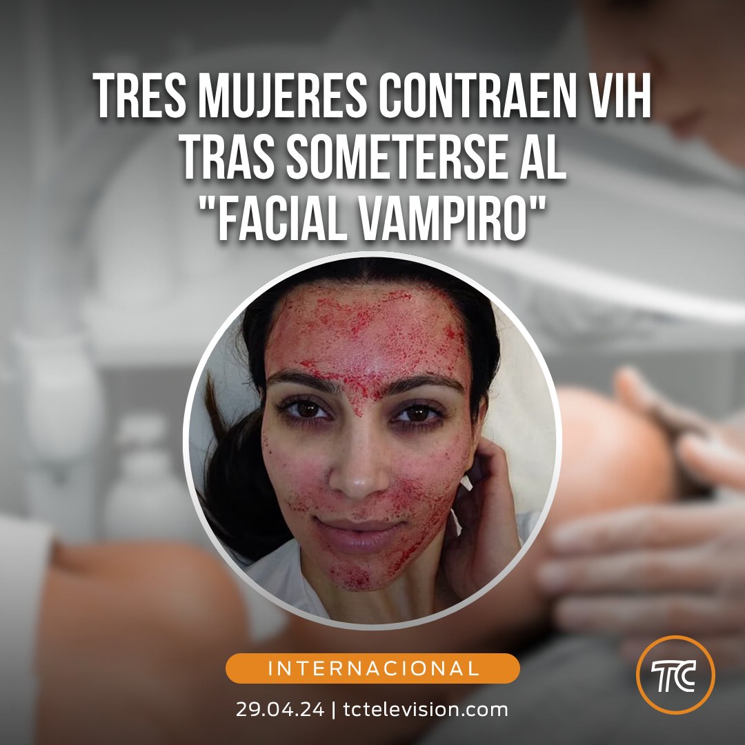¿De qué se trata el tratamiento el 'facial vampiro'? Este procedimiento se lo realizó Kim Kardashian en 2013. » bit.ly/3UCzoHM