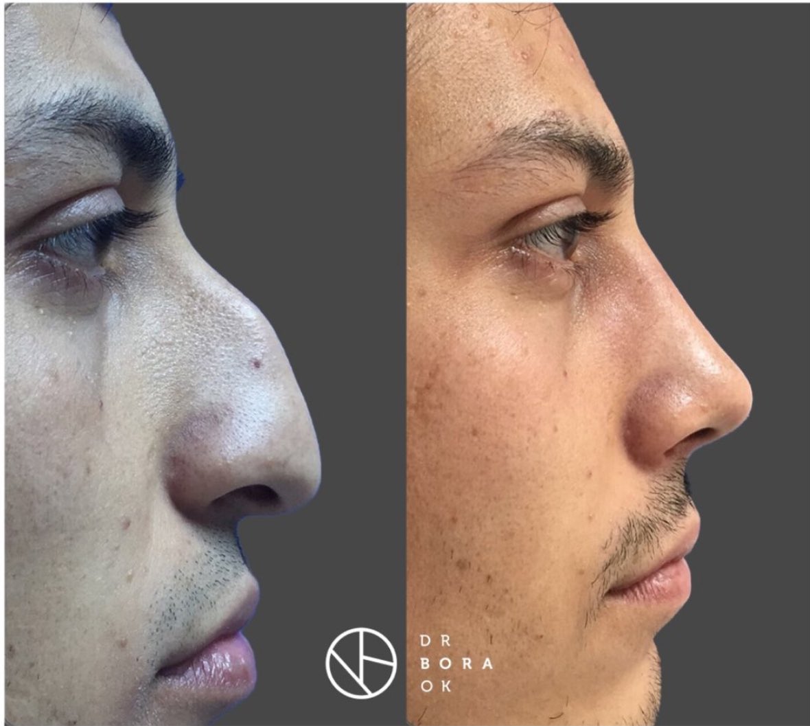 Unlocking a new level of confidence with this rhinoplasty. 👃🏼✨

Rate this transformation!