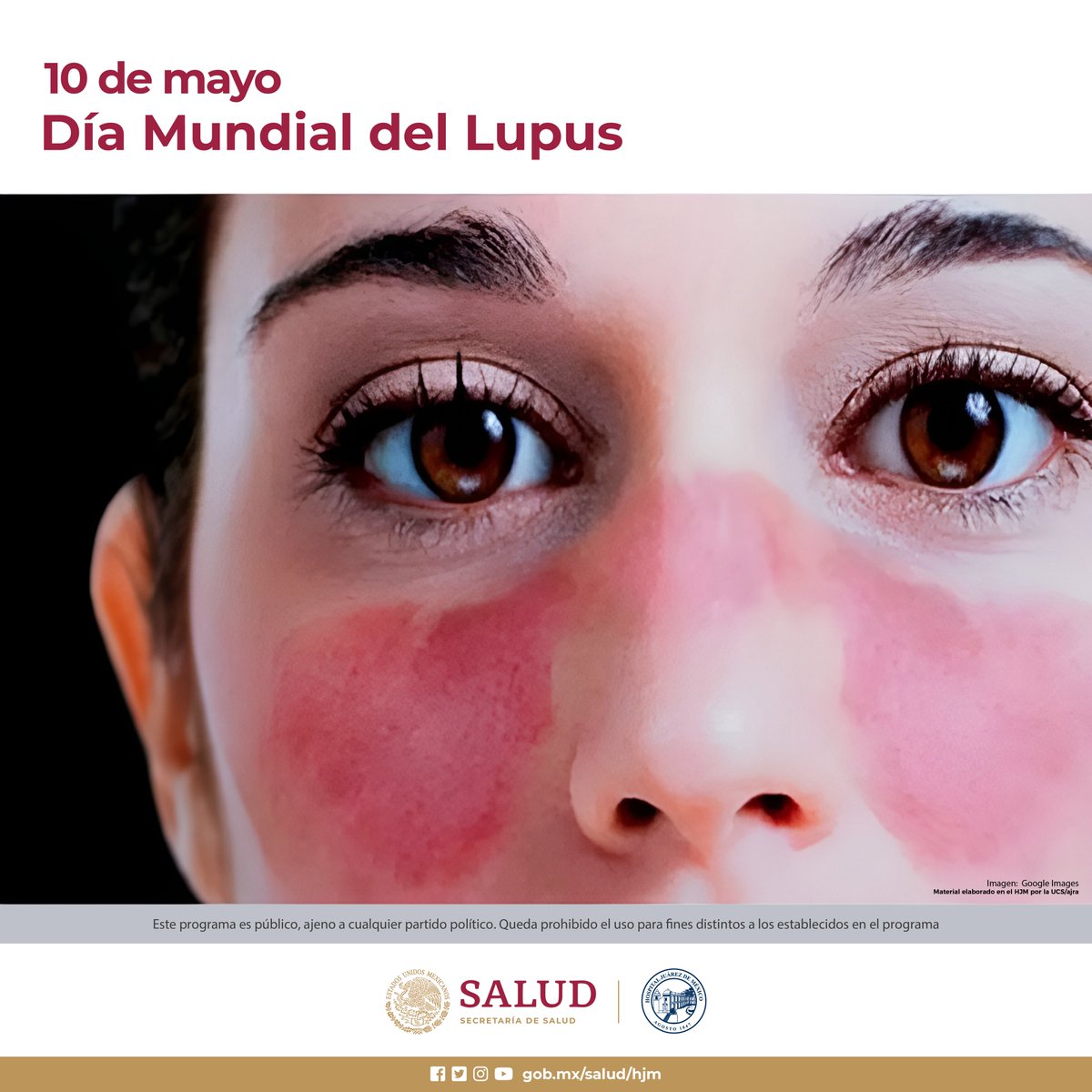Día Mundial del lupus Es crónico pero controlable. Cansancio repentino, fiebre, erupciones rojas en la cara y úlceras en la boca, acude a revisión.
