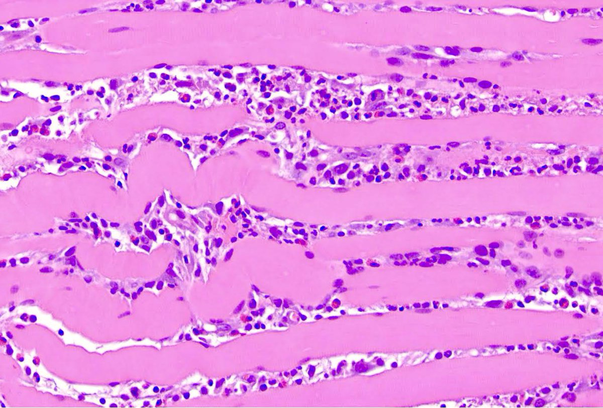 Myositis, panniculitis and tissue eosinophilia

Deep penetrating trauma of the buccal mucosa