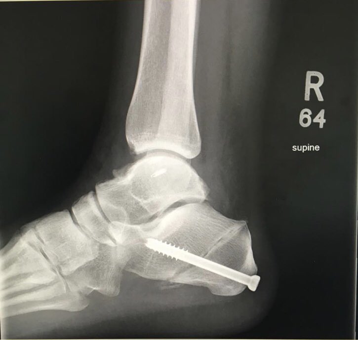 In the interest of Forensic Anthropology & unique identifiers in Disaster Victim Identification (DVI) thought I’d share my ankle x-ray🩻always find it interesting that there is a great big screw in my foot that I can’t even feel! 🦴🕵️‍♀️ #forensicscience #forensicanthropology #csi