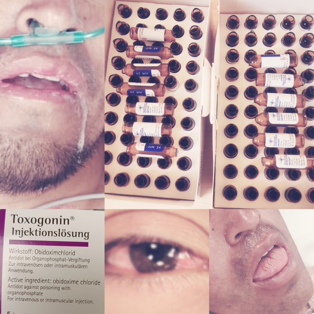 Berrysophie's tweet image. #CodigoToxico en paciente intoxicado por organofosforados, en este caso toxindrome colinérgico con predominancia de  efectos muscarínicos. La atención toxicológica oportuna  #CIATlax es fundamental para salvar vidas Gracias a #SINTOX y al trabajo en equipo de los #Urgenciologos