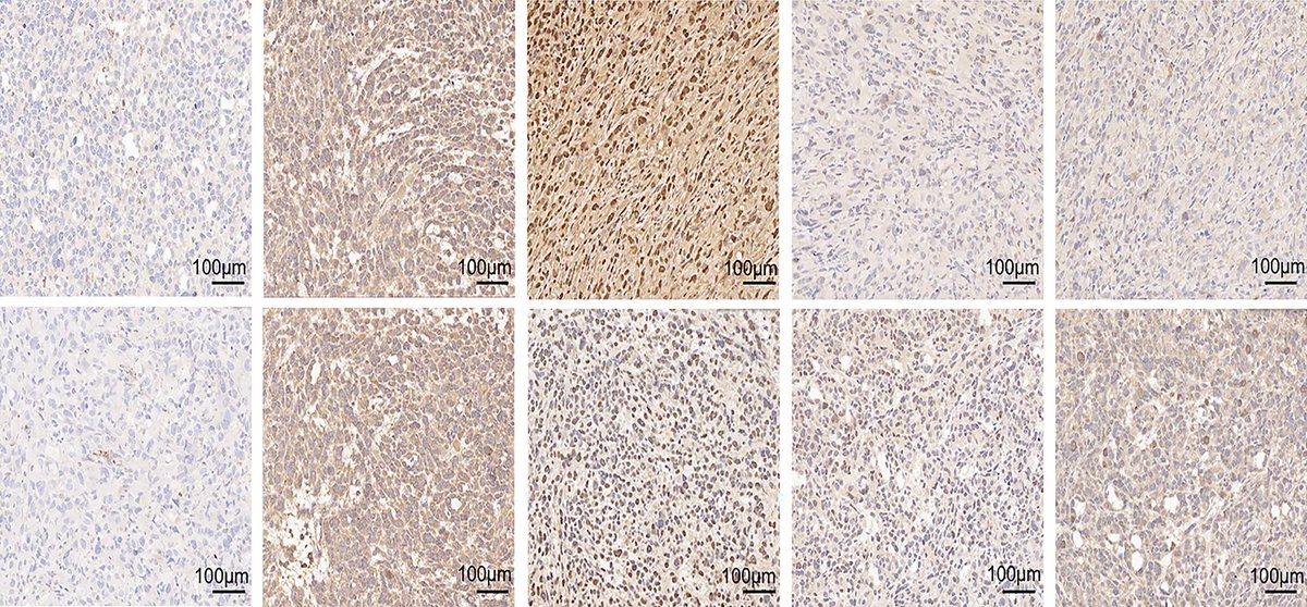 Scientists discovered a previously unstudied differential gene called HIST3H2A in #ProstateCancer. 🔎 Find out about the oncogenic role of this gene: bit.ly/49TlDJr