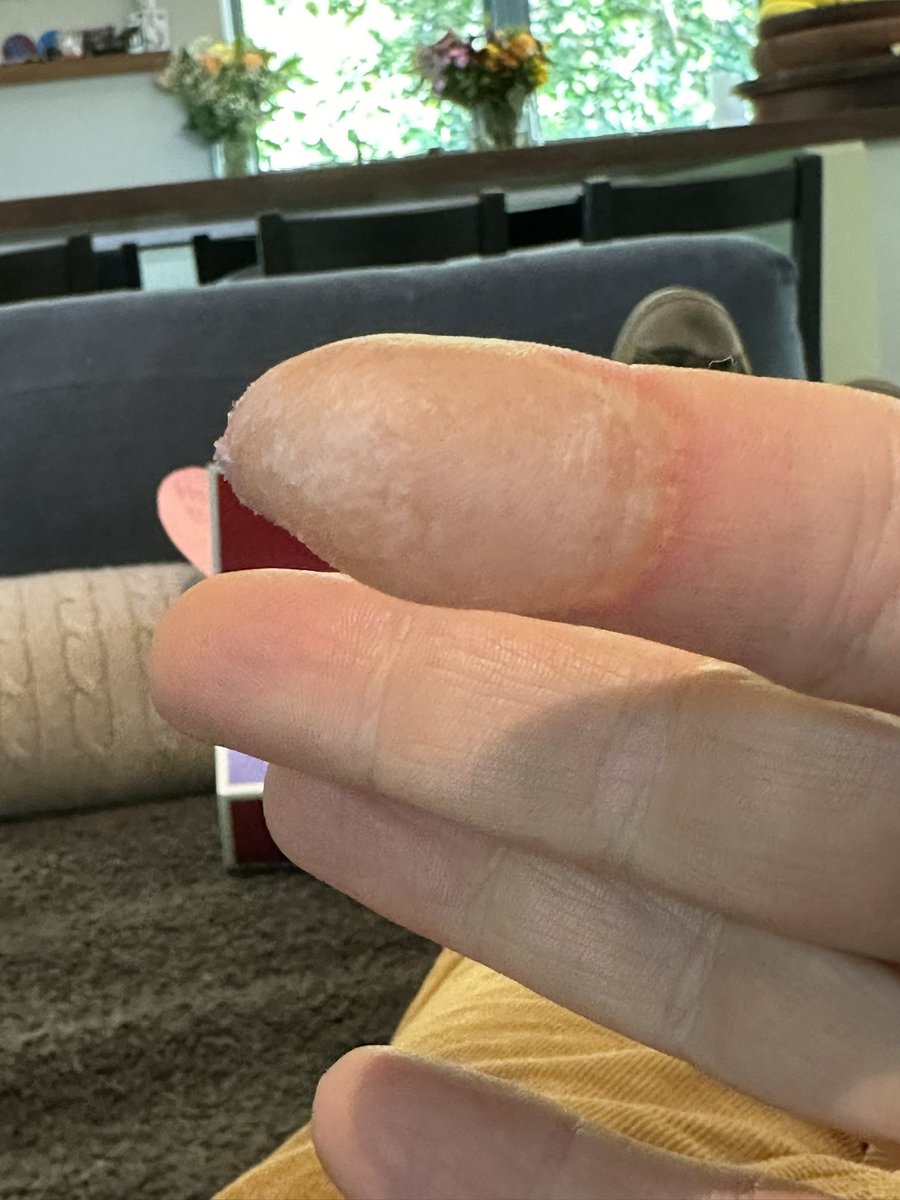 I burned my finger.