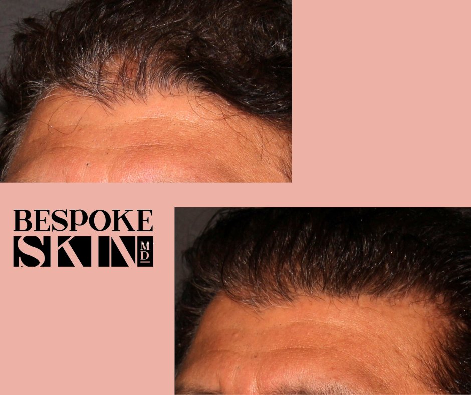 SmartGraft FUE Hair Tranplant or Follicular Unit Extraction uses individual hair follicles from the back of the head and transfers them to enhance thinning hairline
#ygk #kingston #kingstonontario #fue #hairtransplant #malepatternbaldness #hairloss #plasticsurgeon