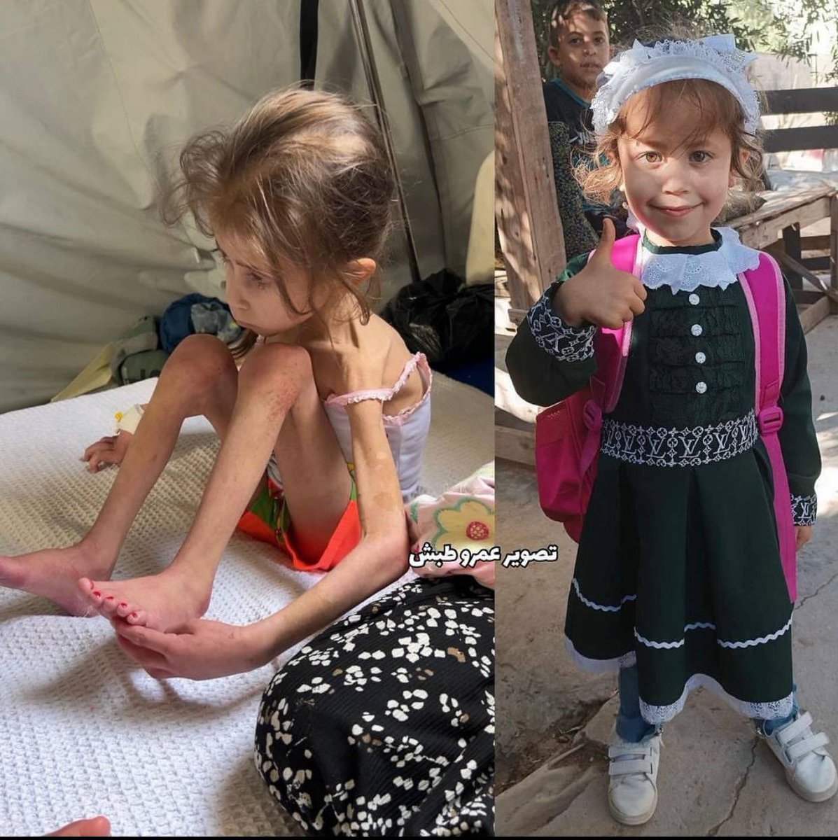 The little girl Jana Ayyad suffers from malnutrition as the aggression continues against Gaza. May Allah ﷻ forgive us if we are ever of the ungrateful 💔