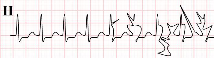 Top 5 Tips to Avoid Misinterpreting the ECG/EKG
buff.ly/4cjmuFq
#emergencymedicine #intensivecare #respiratory #respiratorycare #icu #nurses #icunurse #ecg #ekg #cme #cmeonline