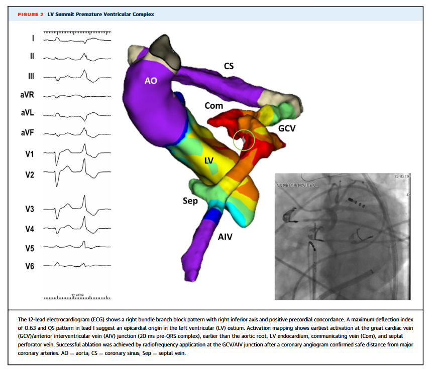 Great map + excellent paper for all #EPeeps
Thank you, @DrFerminGarcia
jacc.org/doi/epdf/10.10…