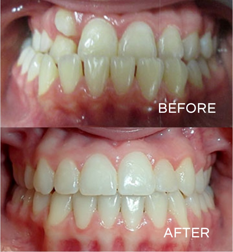 The before photo is of a patient with an underbite & hyperdontia. The after photo was achieved with an extraction & dental braces over a period of 24 months along with monthly maintenance.

#flossdental #thetoothdr #flossboss #beforeandafter #wazioorthodontics #trinidadandtobago