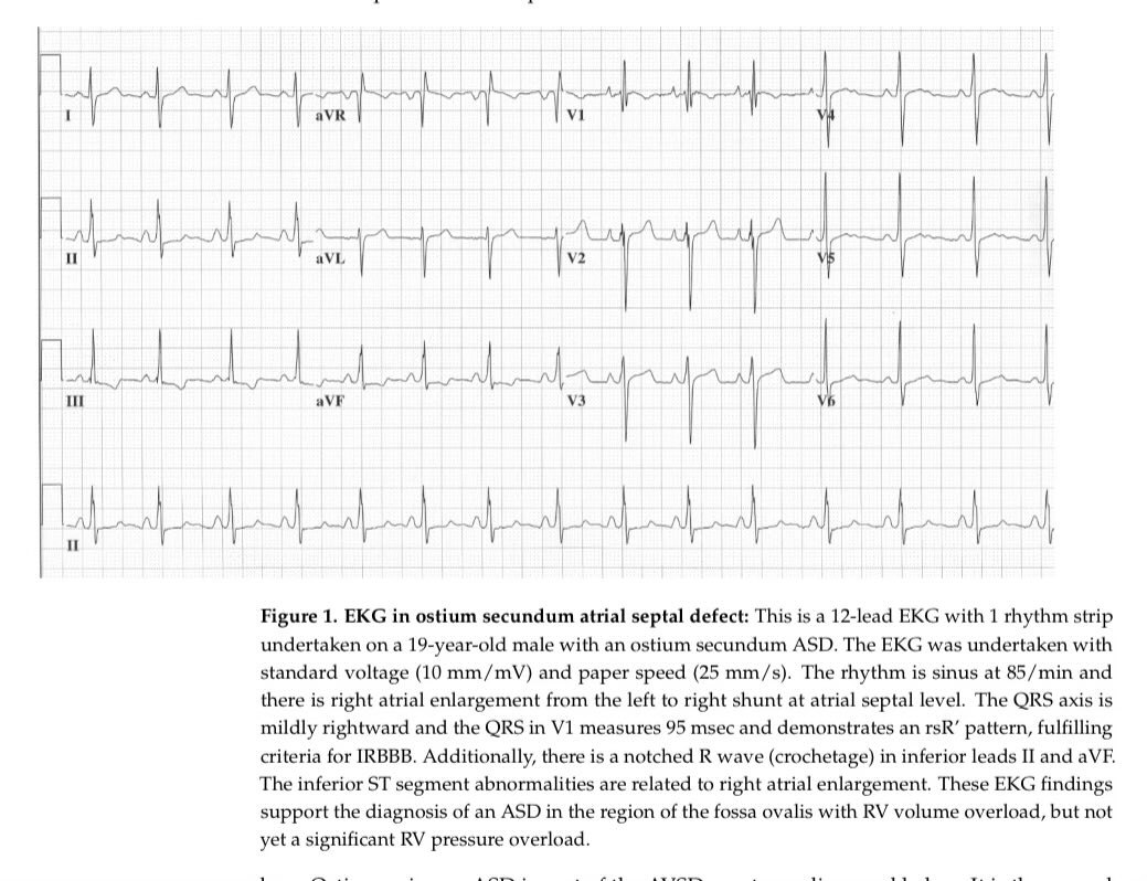 Review The Value of the Electrocardiogram in Adult Congenital Heart Disease doi.org/10.3390/jpm140… #CardioEd