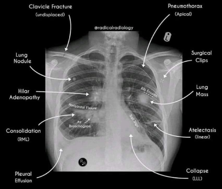 pgMedicine's tweet image. Cxr