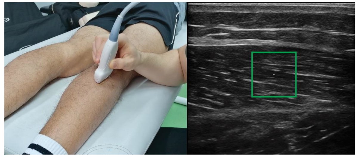 Sensors_MDPI's tweet photo. Using Shear-Wave Elastography to Assess Exercise-Induced Muscle Damage: A Review
https://t.co/mluATC6MBx
@si_upr
#Ultrasound #Soreness #UnderlyingMechanisms #EccentricExercise #ShearModulus https://t.co/eLj2BFWJeu