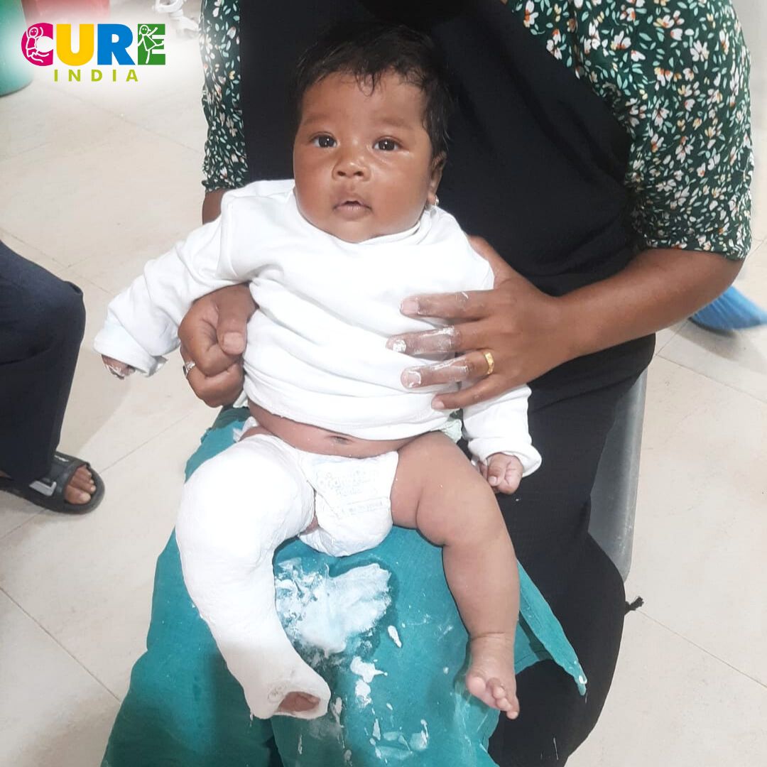 These impactful images showcase the unwavering dedication of our CURE India counselors at Civil Hospital, Meghalaya. With compassion and expertise, they are seen teaching parents the proper technique for wearing foot abduction braces. 

#CUREIndia #ClubfootTreatment