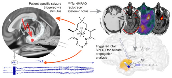 New study led by #InselGruppe and @unibern presents groundbreaking method for recording epileptic seizures, speeding up imaging and optimizing surgical planning. Read more: jnm.snmjournals.org/content/65/3/4…
#EpilepsyResearch #Neurology #NuclearMedicine #Neurosurgery
@MedFacultyUniBE