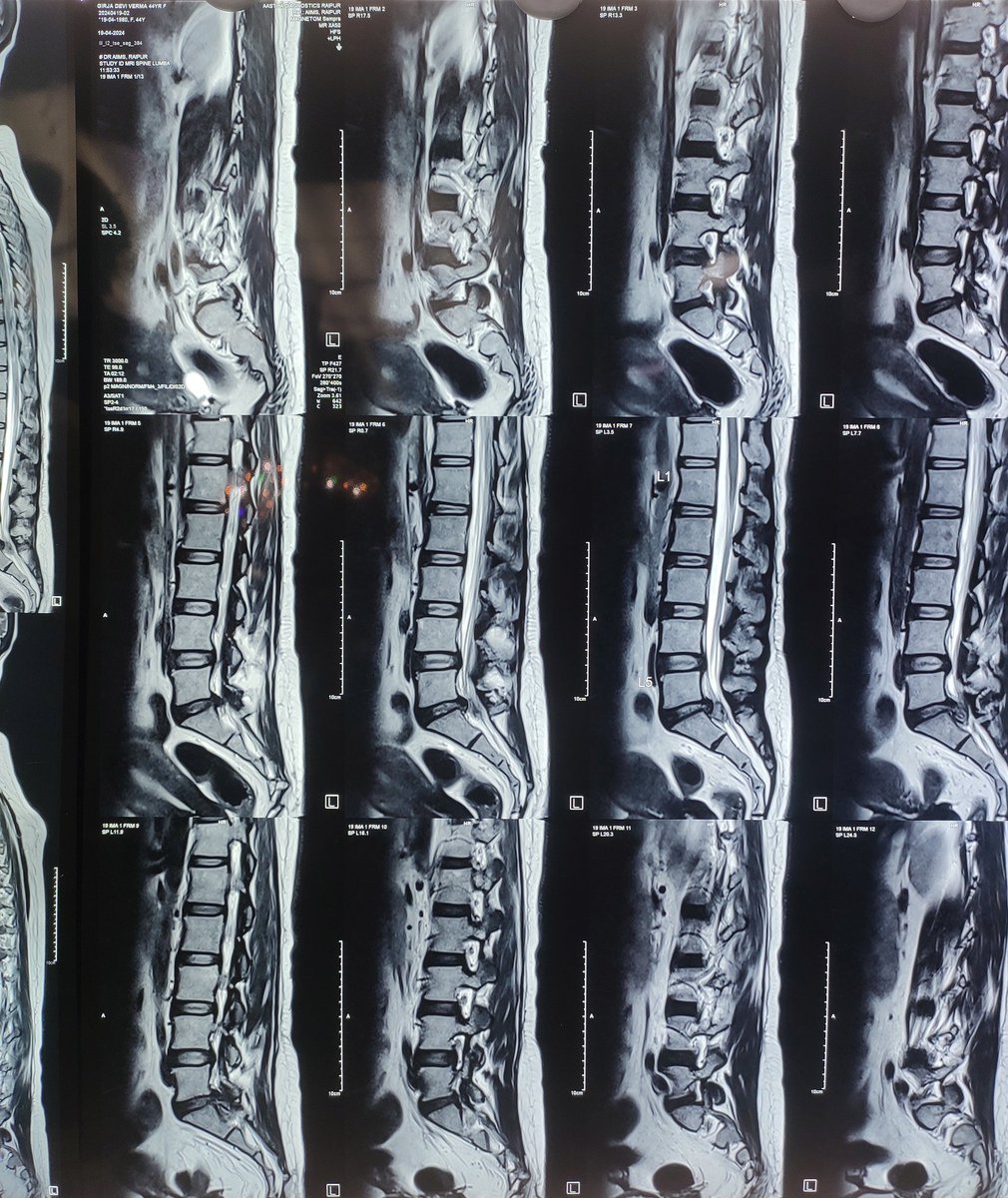 vsimemon's tweet photo. Yesterday's case,
44 Years female with Lower back pain Γ(7-8 month) radiating to left lower limb
Diagnosis: L5-S1 Extruded disc with Paraparesis with cauda equina syndrome Surgical Procedure:- Laminectomy and Discectomy
Anesthesia: GA
position: prone
#otawareness https://t.co/bFqSWaGsn2