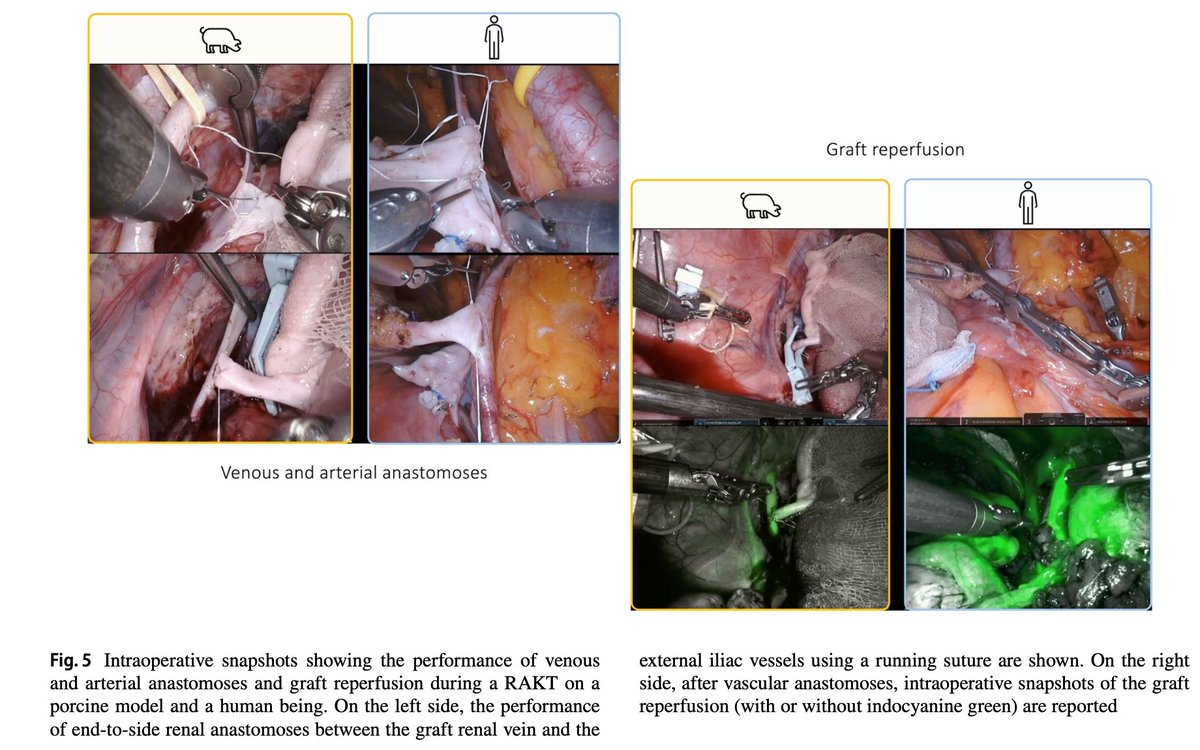 1) The @ERUSrobotics #course on robot-assisted kidney transplantation @orsiacademy @AlbertoBreda1 @KarelDecaestec1 @AngeloTerrito @YAU_Transplant @Fede_Piramide @alexmottrie pubmed.ncbi.nlm.nih.gov/38554210/ Supplementary video: doi.org/10.1007/s00345….