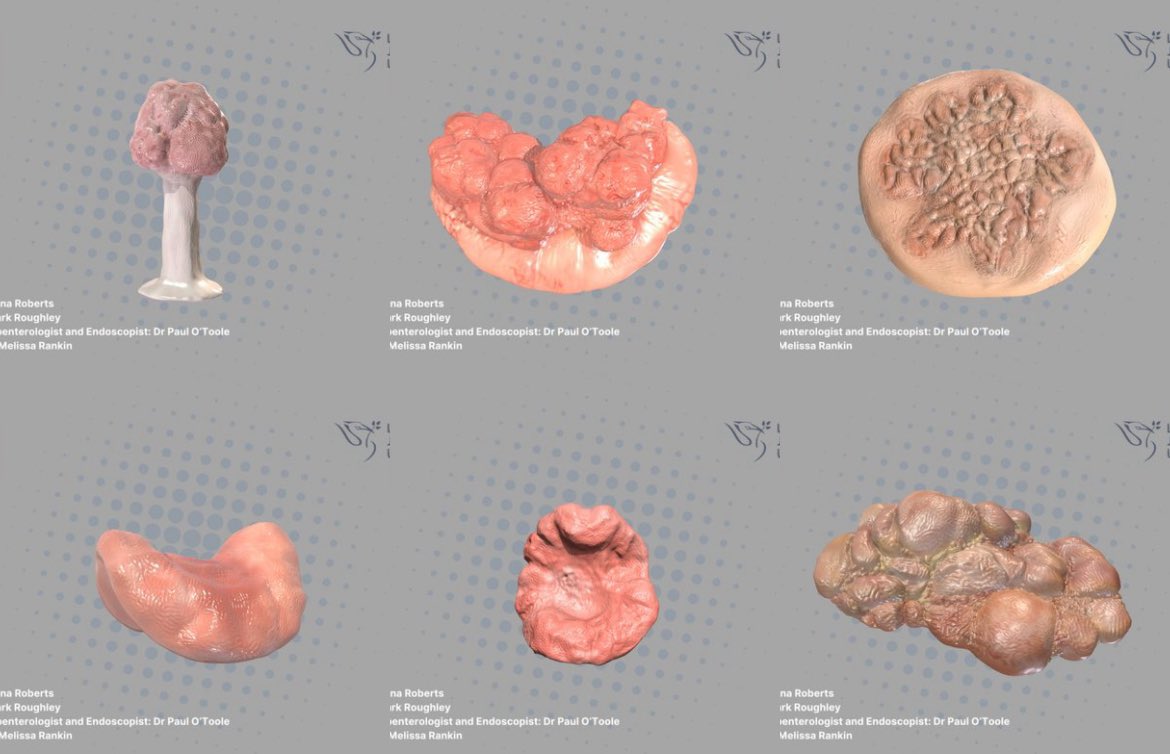 Wonderful to see Melissa Rankin presenting our poster on the development of ‘3D Models as Teaching Aids for Large Colorectal Polyp Assessment’ (Roberts, A., Rankin, M., O’Toole, P. & Roughley, M. 2024) at #esgedays2024. Check out the models here > skfb.ly/oRFJo