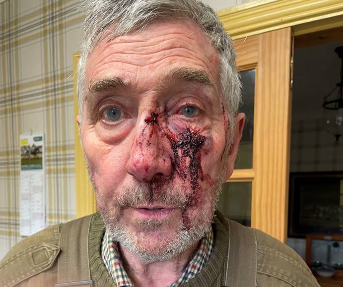 These are the shocking injuries suffered by the victim of a serious assault in Cropton, Pickering. ⬇

It happened on Saturday 20 April, and involved three men riding mountain bikes, one of whom punched the victim.

We're investigating. Can you assist? orlo.uk/Ft2jP