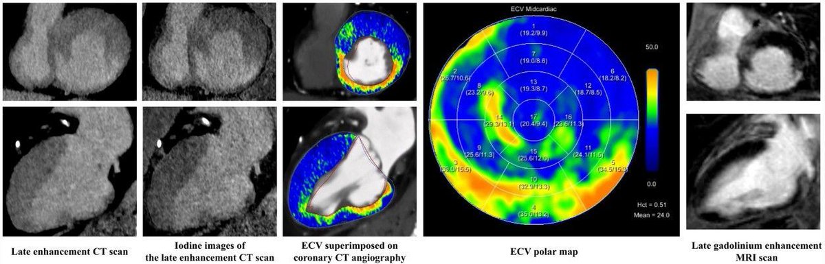Educational Review: Myocardial extracellular volume quantification with computed tomography—current status and future outlook. (Giulia Cundari et al., @Alkadhi_rad)

#InsightsIntoImaging

🔗 buff.ly/49RpvKT
