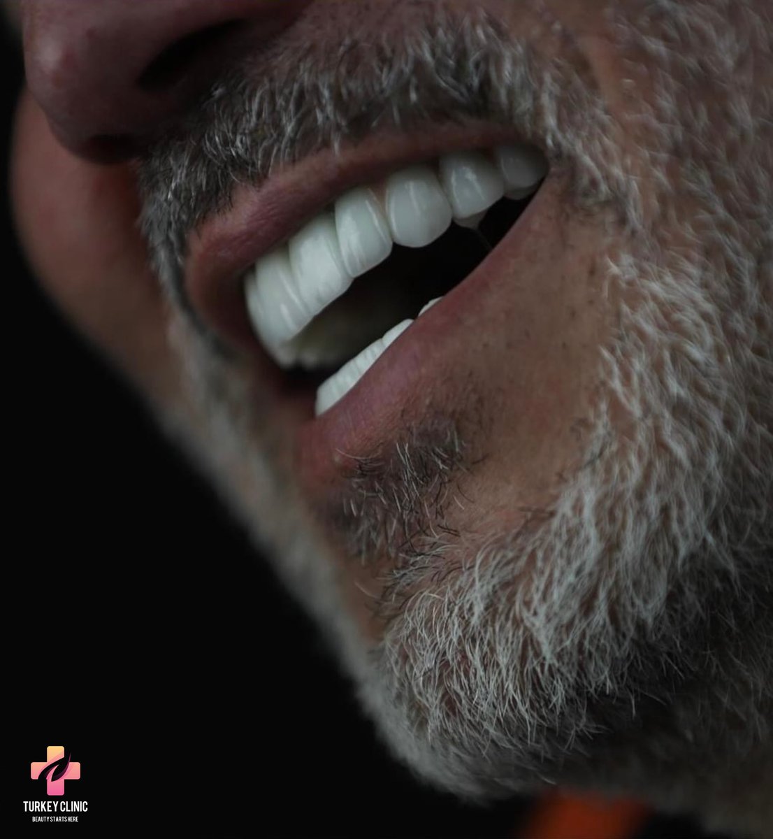 #istanbul #hollywoodsmile #dentalphotography #dentistry #estheticdentistry #dentalveeners #veeners  #zirconium #dentaltourism #dentalclinic #smiledesign #dentalcare #dentist #dentalimplants #teeth #teethwhitening #hollywoodsmilestudio #teethwhiteningkit #dentistryworld