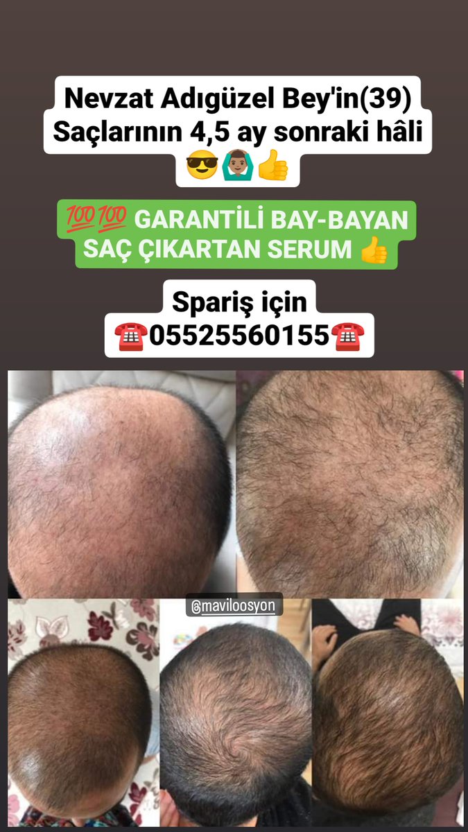 HAYIRLI SABAHLAR 🤲 💯💯 GARANTİLİ SAÇ ÇIKARTAN SERUM 😎 👉 MUTLAKA DENEYİN ✅SAÇI DÖKÜLMESİNE SON ❌ ✅ SAÇLARINIZ YENİDEN ÇIKSIN 👍 👉 DÜNYANIN HER YERİNE KARGO🌍 👇SPARİŞ İÇİN 👇 ☎️05525560155☎️