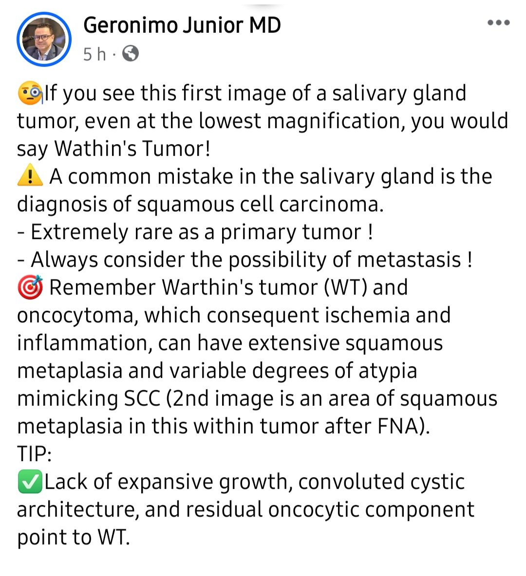 Salivar gland SCC ?

#entpath #pathology