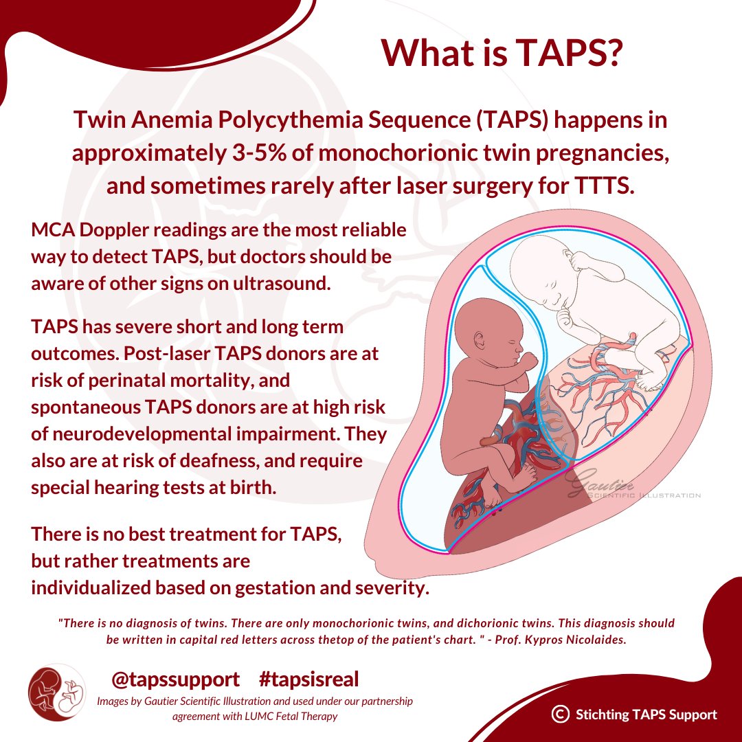 What is TAPS in Twins? Twin Anemia Polycythemia Sequence, or TAPS as it’s better known, is a rare disease affecting twins sharing a placenta. Learn more on our website: bit.ly/32AXytG #tapssupport #tapsisreal